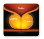 enlarged prostate diagram